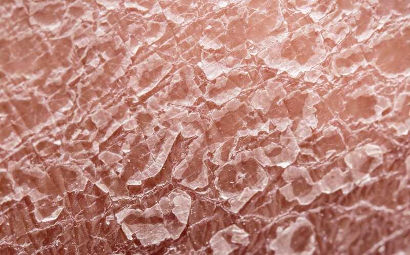 Врожденный ихтиоз можно лечить с помощью генного редактирования клеток кожи