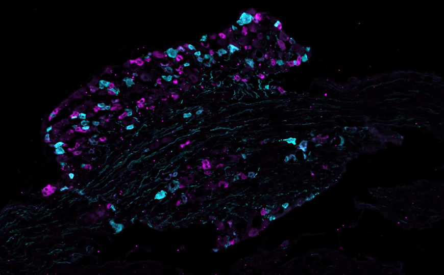 Составлена первая карта боли на уровне белков