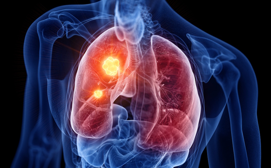 (Не)мелкоклеточный рак легкого: смешанная опухоль возникает из одного клона