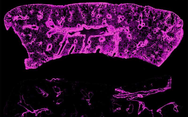 Нарушение оттока лимфы провоцирует фиброз пересаженных легких