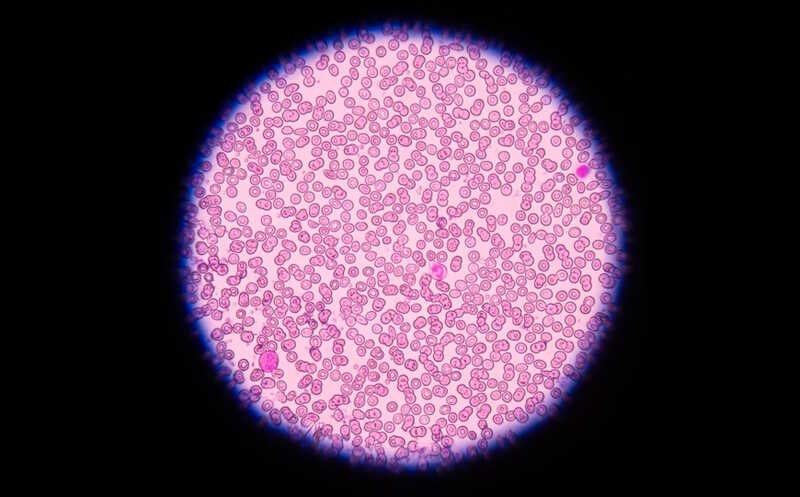 Исследователи из Шанхая применили редакторы оснований для лечения β-талассемии