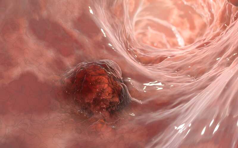 Хроническое воспаление повышает риск рака через «эпигенетическую память»