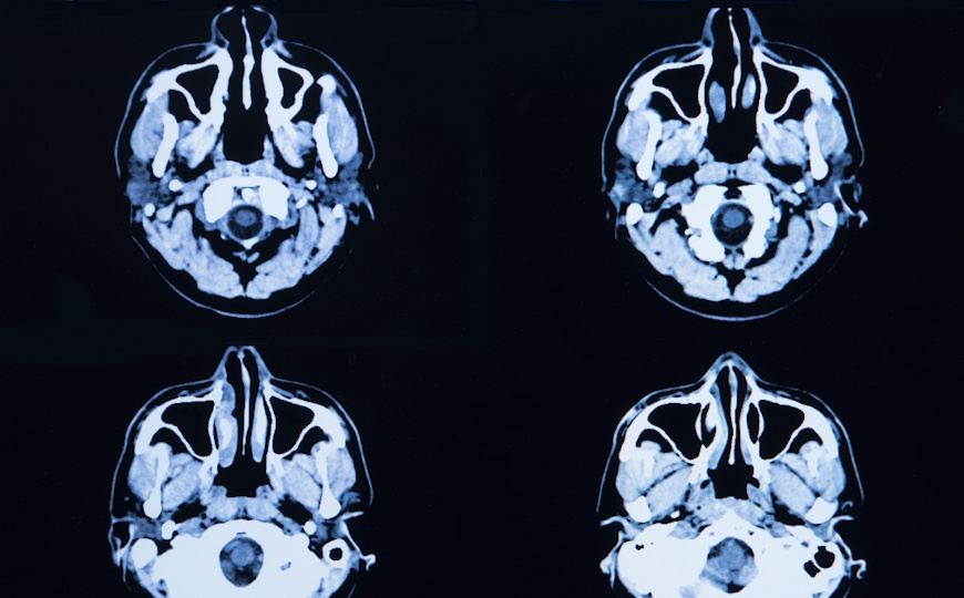 Женщины быстрее накапливают тау-белок при α-синуклеинопатии