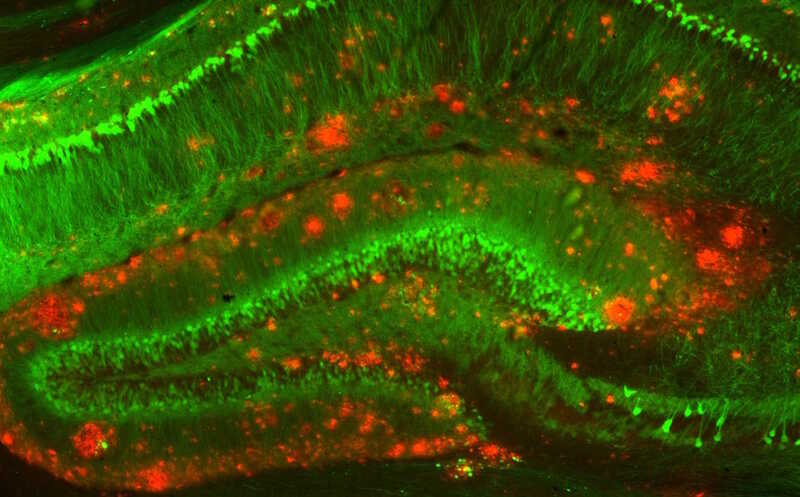Амилоидную и тау-белковую гипотезы развития болезни Альцгеймера может примирить взаимодействие с микротрубочками нейрона