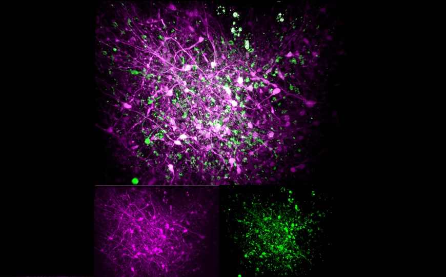 Влияние синдрома Ретта на раннее развитие мозга зависит от типа вызвавшей его мутации
