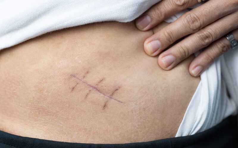 Регенерации кожи препятствует активный рост нервов вокруг раны