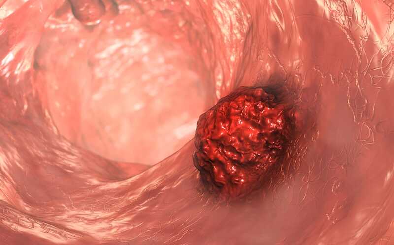 Набор T-клеточных рецепторов отличает людей с синдромом Линча от здоровых