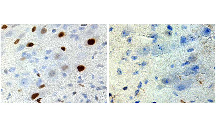 Атрофия нейронов при болезни Кеннеди запускается всплеском тестостерона сразу после рождения